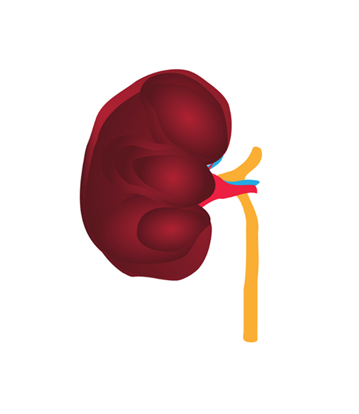 Kidney Stage 4 Image Kidney Stage 4 Image